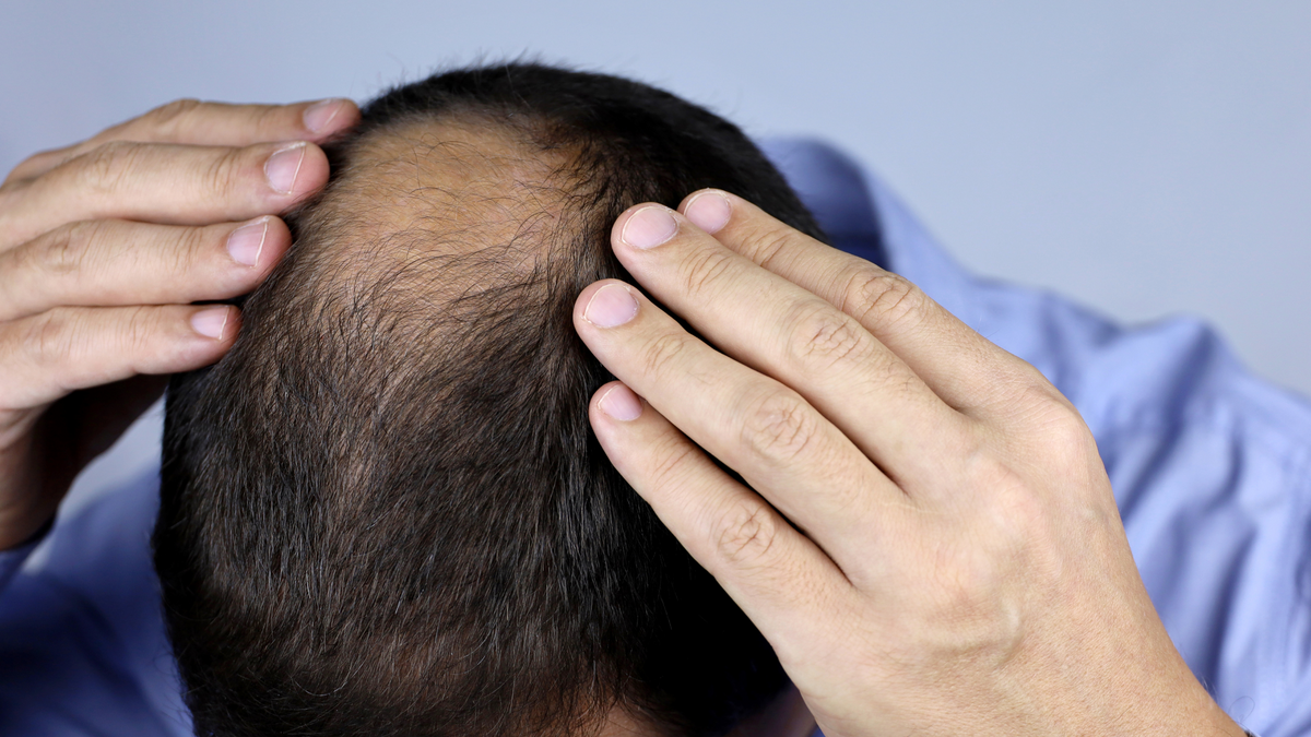 Understanding Men's Hair Loss: The Causes and Treatment – Dr Yates MD